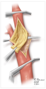 Carótidas vascular
