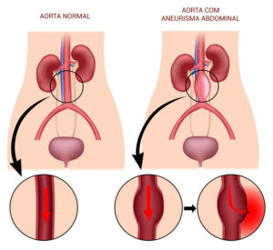 aorta-2