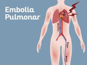 Embolia Pulmonar
