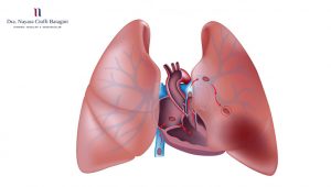 Embolia Pulmonar: Saiba o Que Causa e Como Prevenir