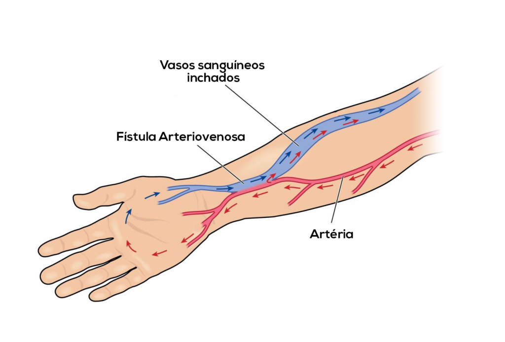 fistula-arteriovenosa