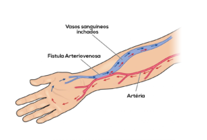 fistula-arteriovenosa