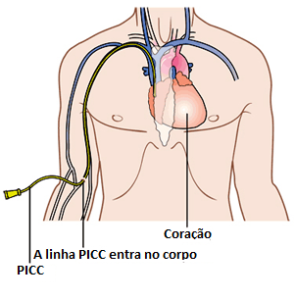 Cateter de PICC