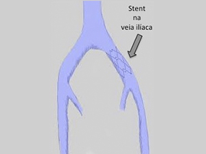 Síndrome