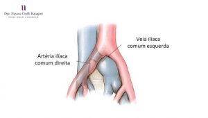 Síndrome de May-Thurner/Cockett - Entenda a Doença e Saiba Como Tratar