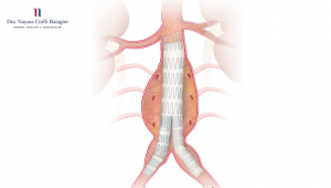 Aneurisma da aorta abdominal tem tratamento?
