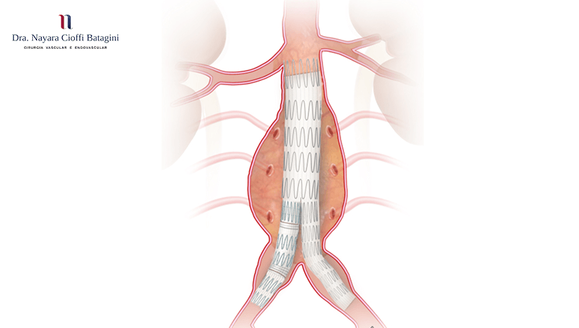Aneurisma da aorta abdominal tem tratamento?