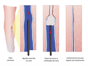 Conheça o tratamento de varizes com espuma