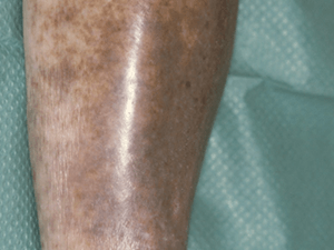 O que é dermatite ocre e por que ela aparece?