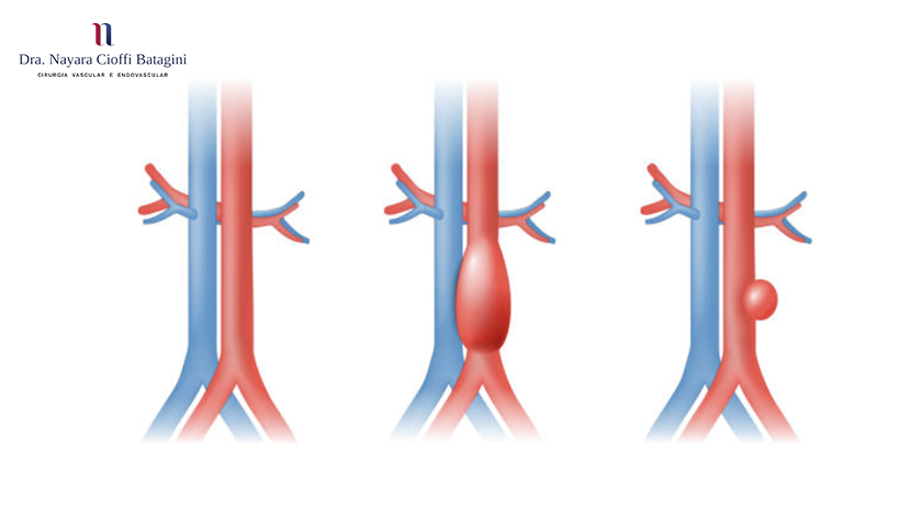 Quais são os sintomas do aneurisma da aorta abdominal?
