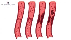 3 Sinais Típicos de Trombose Venosa Profunda