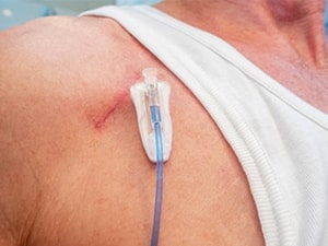 Cateter Port-A-Cath para Quimioterapia