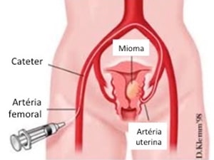 Tratamento de Embolização para Mioma