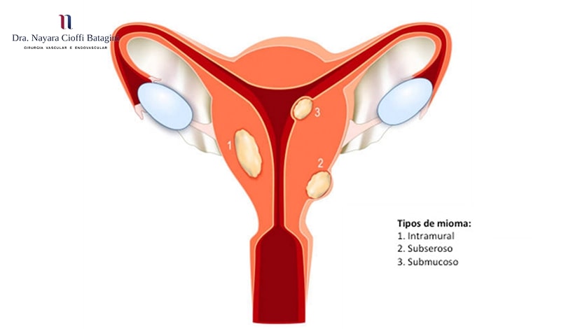 Tratamento de Embolização para Mioma