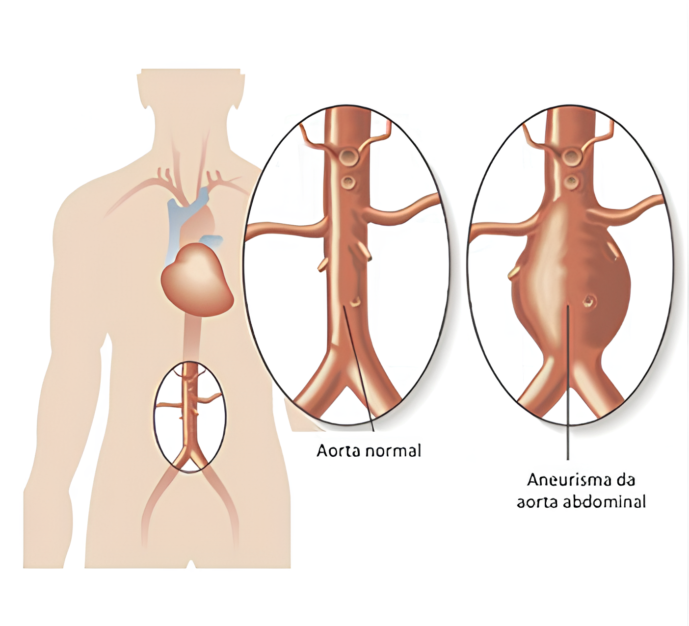 Aneurismas