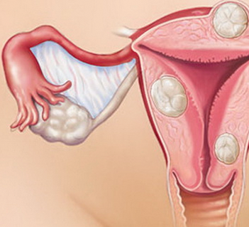 Embolização de Miomas Uterinos