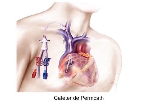 Cateter permcath