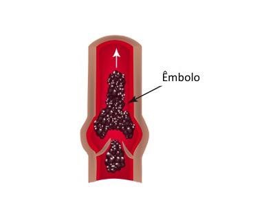 O que causa a Embolia Pulmonar