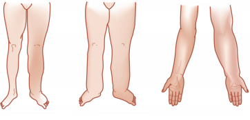 Sintomas do Linfedema