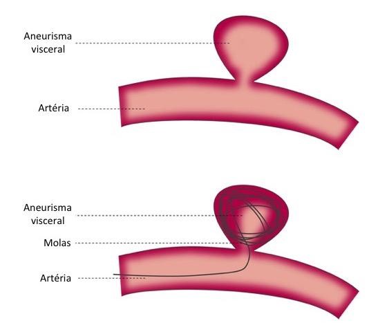 Tratamentos com foco em Endovascular e Minimamente Invasivo