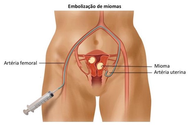 Como funciona a embolização de miomas uterinos