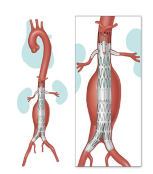 Tratamento com a técnica endovascular