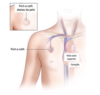 Cateter Totalmente Implantável (Port-a-Cath)