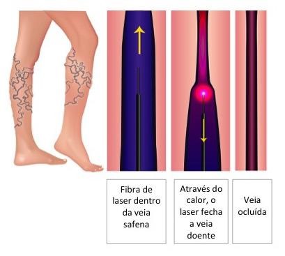 LASER Endovenoso para Veia