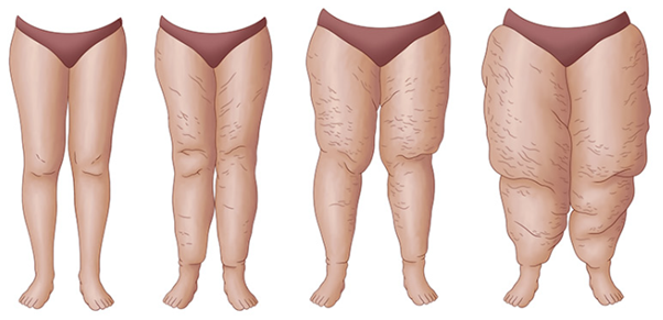 O que é o Lipedema?