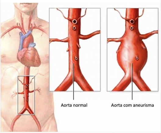 Aorta com aneurisma
