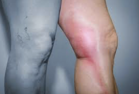 Tromboflebite