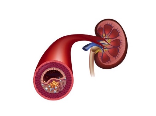 Foto-1-Estenose-de-arteria-renal